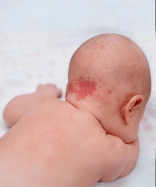 birth mark removal in bhubaneswar