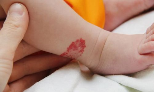 birth mark removal