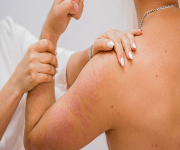 Psoriasis treatment in bhubaneswar