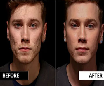 Acne scar surgery in bhubaneswar