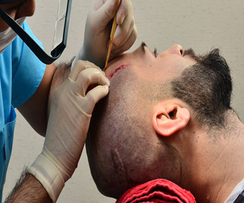 hair transplant in bhubaneswar