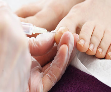 Nail surgery in bhubaneswar