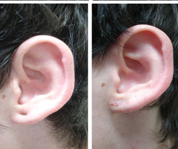 Earlobe surgeries