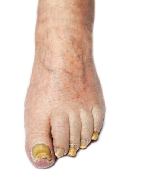 fungal infection treatment in bhubaneswar