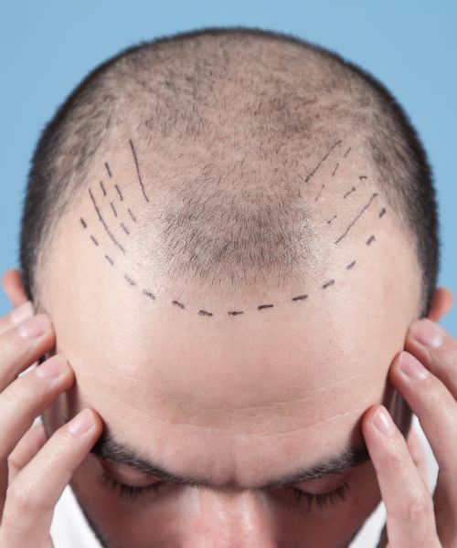 hair transplant in bhubaneswar