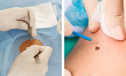 mole removal in bhubaneswar