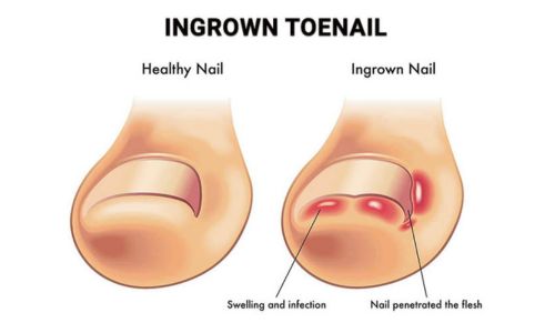 Nail Surgery in bhubaneswar