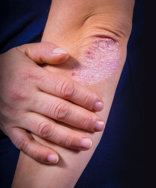 psoriasis treatment in bhubaneswar