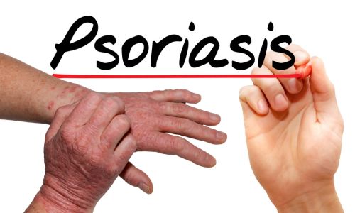 Psoriasis doctor in bhubaneswar