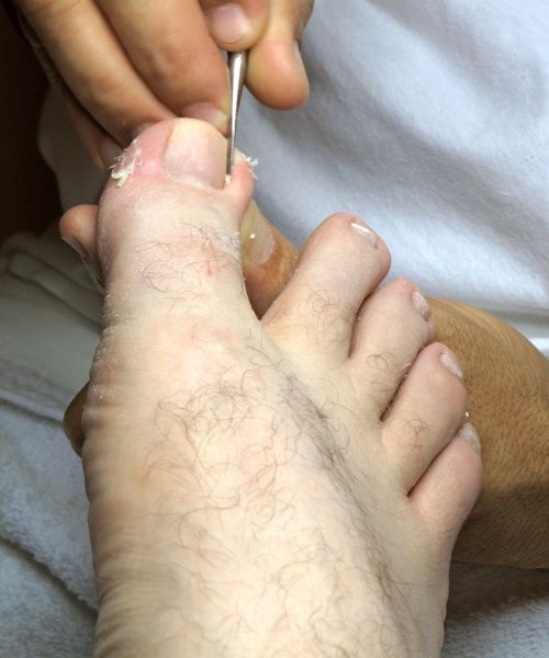 toenail removal in bhubaneswar