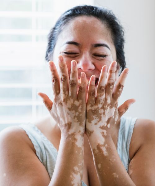 vitiligo treatment in bhubaneswar